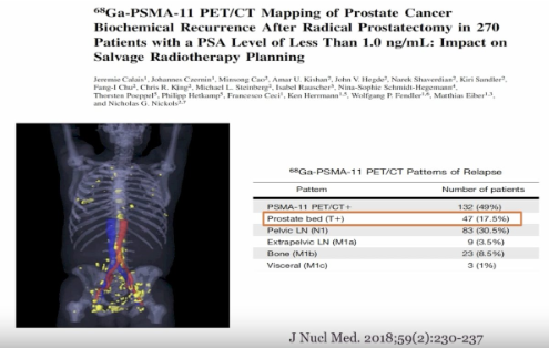 urotoday's tweet photo. Macroscopic local relapse after RP in the context of high-risk #nmHSPC. Presentation by @PCaParker @royalmarsdenNHS. #EAU26 written coverage by @RKSayyid @UAUrology > https://t.co/ogdFusOcGv @Uroweb https://t.co/PYAgyzTfLB