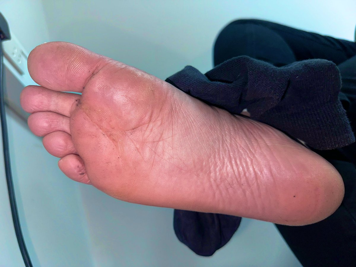 F33T111's tweet photo. My feet are sweating so much I had to peel my sock off. Who’s daring enough lick it clean for me? 👅🦶🏻

Like & Share 🔃 Tips welcome via Throne (link in bio)

#feetworship #mensfeet #footfetish #gayfeet #menssoles #feet #feetfetish #feetaddict #feet #malefeet #footworship #malefootfetish #soles #solesandtoes #toes #maletoes #worshipmensfeet #gayfootfetish #macro #barefeet #footmaster #macrophilia #macrophile #malefeetlovers #malefeet