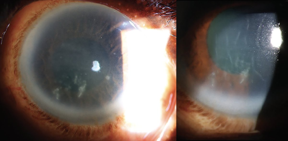 revoptom's tweet photo. "What the Wind Brought" — When encountering this common corneal infection, time is vision.

A 73-year-old man presented with pain, photophobia and foreign body sensation in the left eye for two days. Full case: https://t.co/TTA87Z3sc4

#optometry #optometrist #eyecare #cornea https://t.co/wpZ6zKbKuG