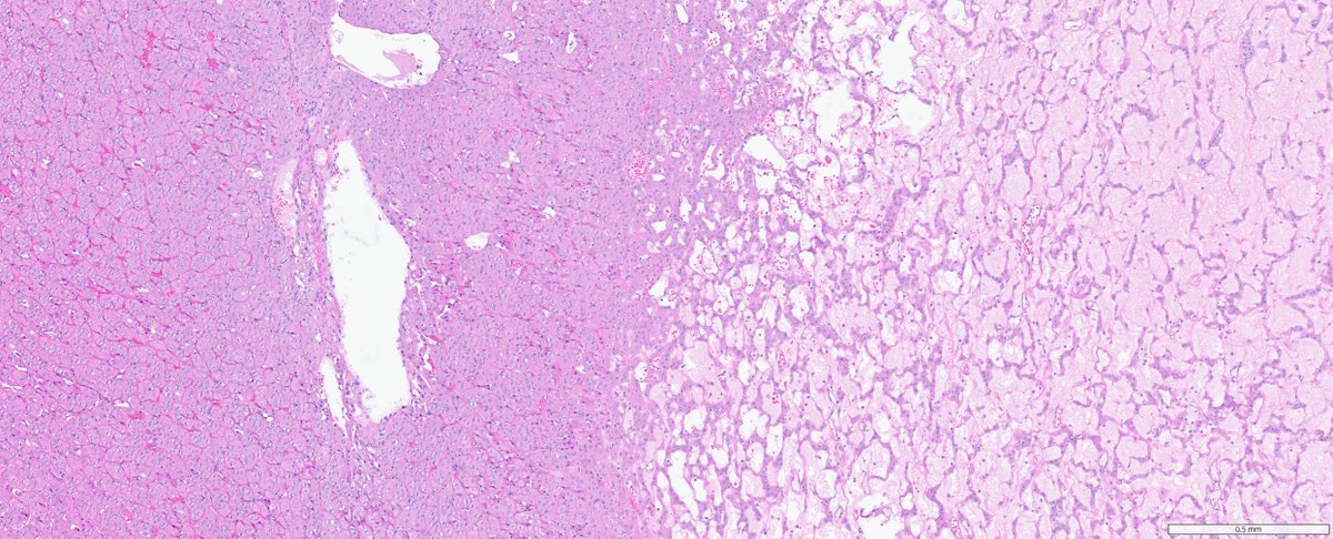 slusagar's tweet image. #GUpath #grosspath nephrectomy with central scar:

DDx: oncocytoma, chromophobe RCC...but also LOT!

🔬compact nests, loose cord-like nests floating in stroma, lymphocytic aggregates 
🎨pos CK7/GATA3/L1CAM, neg CD117/CK20, retained SDHB 
🧪another entity in TSC/MTOR family