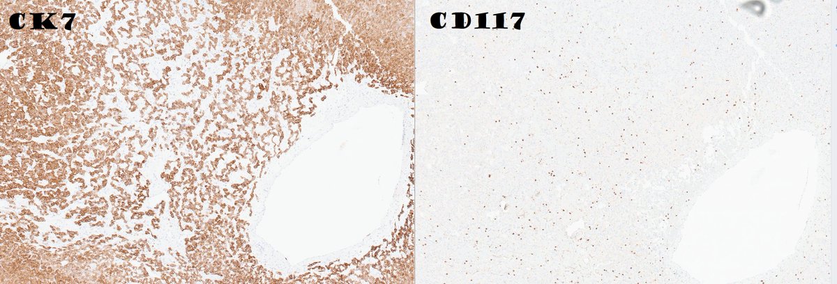 slusagar's tweet image. #GUpath #grosspath nephrectomy with central scar:

DDx: oncocytoma, chromophobe RCC...but also LOT!

🔬compact nests, loose cord-like nests floating in stroma, lymphocytic aggregates 
🎨pos CK7/GATA3/L1CAM, neg CD117/CK20, retained SDHB 
🧪another entity in TSC/MTOR family