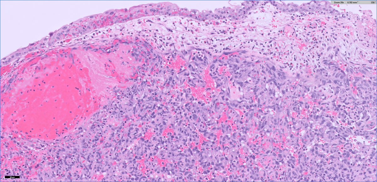 slusagar's tweet photo. #GUpath TURBT: metastatic angiosarcoma

DDx
▪️sarcomatoid uro ca
▪️pseudoangiosarc pattern uro ca
▪️Kaposi sarcoma
▪️hemangioma https://t.co/UvyvikKyRC
