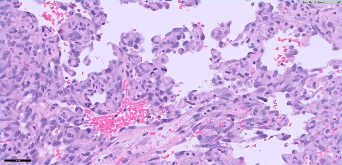 slusagar's tweet photo. #GUpath TURBT: metastatic angiosarcoma

DDx
▪️sarcomatoid uro ca
▪️pseudoangiosarc pattern uro ca
▪️Kaposi sarcoma
▪️hemangioma https://t.co/UvyvikKyRC
