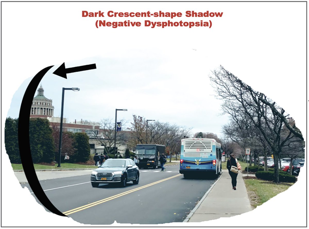 revoptom's tweet image. "Doc, What’s Dys?" — Unwanted visual phenomena can bother some patients after cataract surgery.

🔸Q: I sometimes hear patients mention dark shadows or other vague visual disturbances after cataract surgery. What should I tell them?

🔸A: reviewofoptometry.com/article/doc-wh…

#optometry