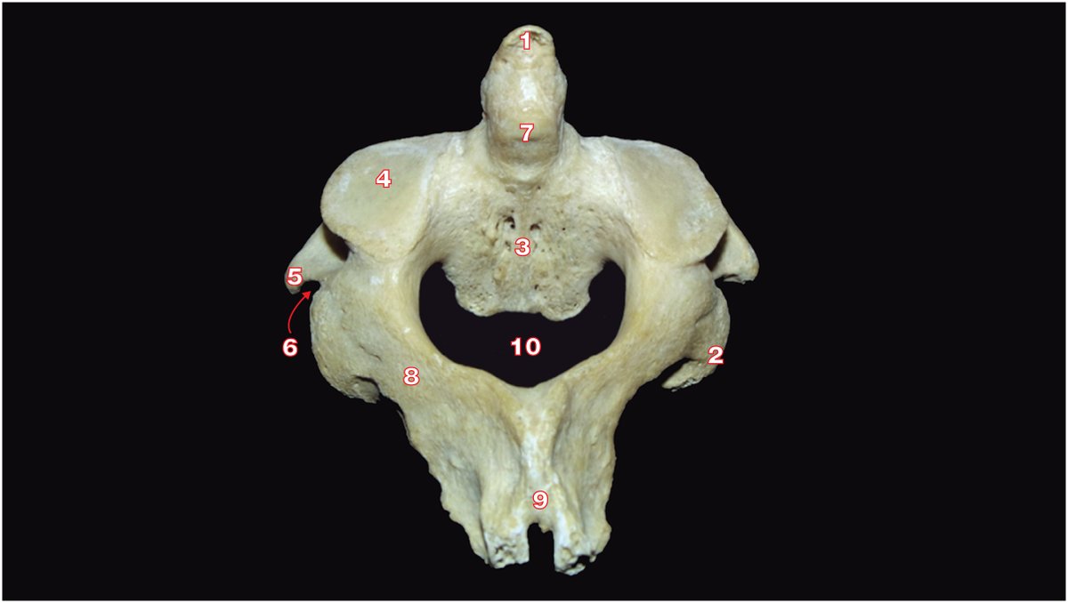 PasionAnatomia's tweet photo. #Axis (vista posterior)
📌1 #Vértice del #diente
📌2 #ApófisisArticularInferior
📌3 #CuerpoVertebral
📌4 #CarillaArticularSuperior
📌5 #ApófisisTransversa
📌6 #ForamenTransverso
📌 7 Superficie articular posterior del diente
📌8 #Lámina https://t.co/BFd84kwDcz