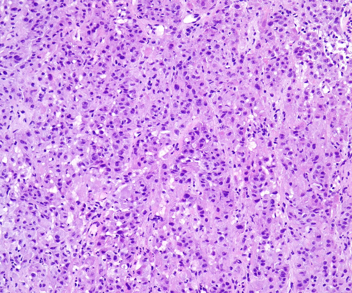 MirunaPopescu13's tweet photo. EBB from a middle-aged F with a dual clinical history. One of them is breast cancer some years ago.

What does #pathtwitter think?🔬
#lungpath #thoracicpath https://t.co/IP905NGEM3