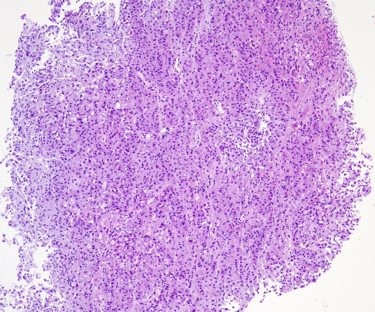 MirunaPopescu13's tweet photo. EBB from a middle-aged F with a dual clinical history. One of them is breast cancer some years ago.

What does #pathtwitter think?🔬
#lungpath #thoracicpath https://t.co/IP905NGEM3