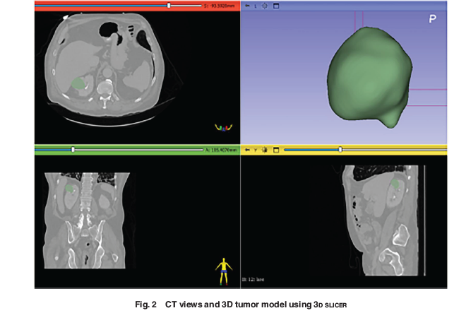 ASMEJournals's tweet image. Radio frequency ablation of #kidney tumor using gold #nanoparticles. asmedigitalcollection.asme.org/heattransfer/a…
#tumors