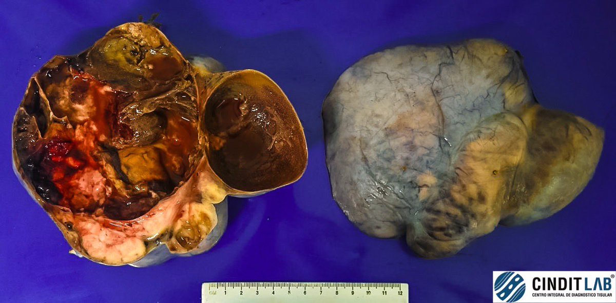 md_castaneda23's tweet photo. Disgerminoma de ovario
#cinditlab https://t.co/luASp9fX8W