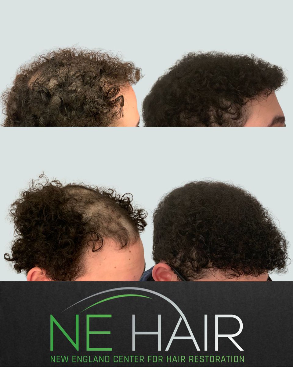 nehair's tweet image. 3K grafts ⚡️⁠ One Year Follow Up
⁠
microFUE Hair Transplant⁠ ⚡️⁠
⁠
⁠

⁠

⁠
⁠
#microfue #fuehairtransplant #hairtransformation #hairtransplantUSA #hairtransplantboston