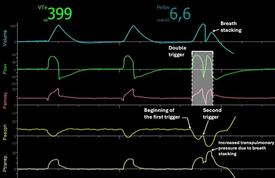 Society of Mechanical Ventilation tweet media
