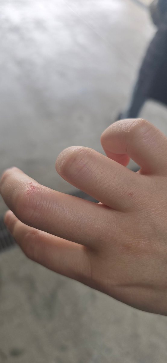 なんか、お墓で手は怪我してるし、多分昨日やけどもしてる……

注意力散漫ですねぇ……
春だからかな