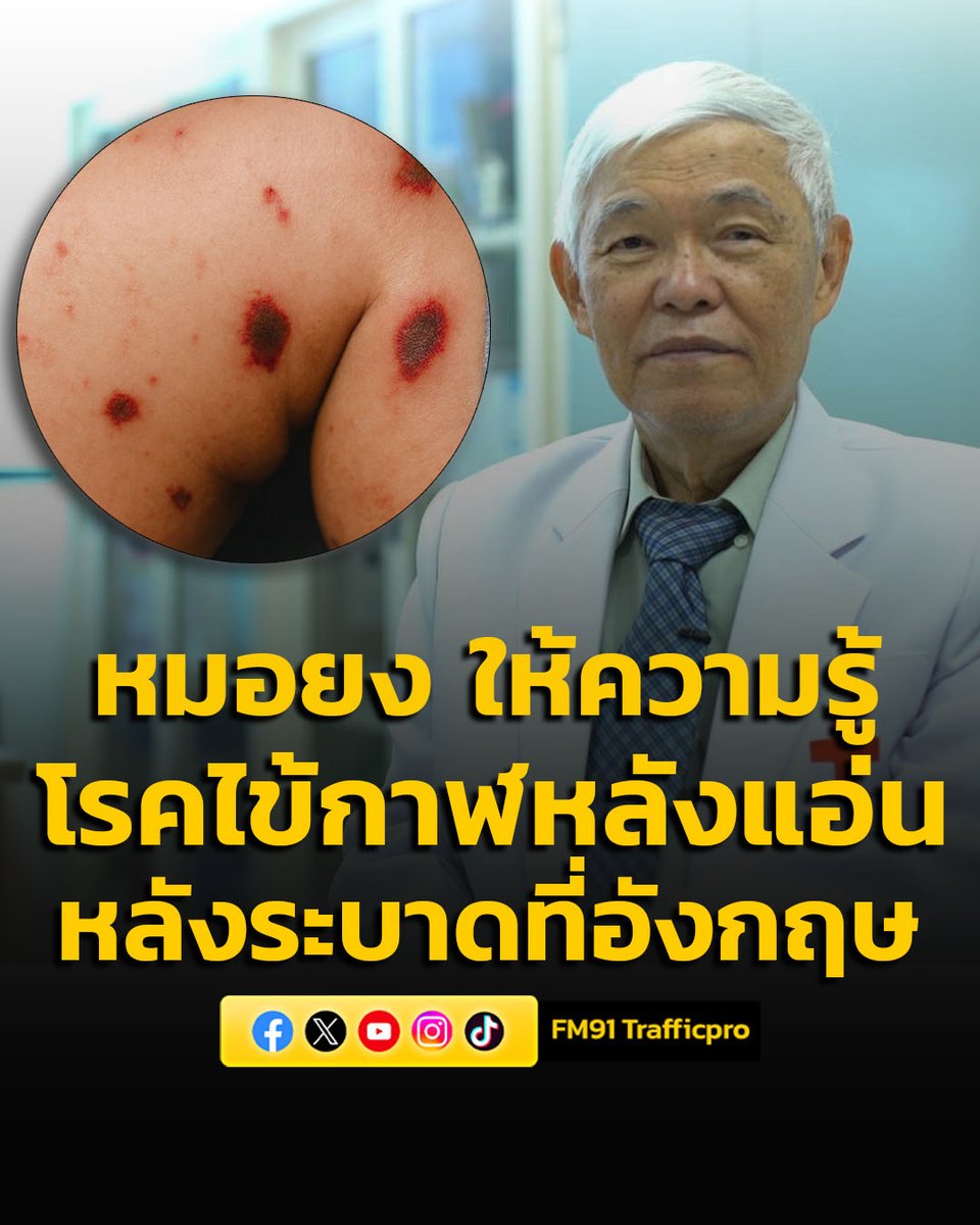 หมอยง ให้ความรู้ "โรคไข้กาฬหลังแอ่น" หลังพบระบาดหนักที่อังกฤษในกลุ่มนักเรียน #หมอยง #ความรู้ #กาฬหลังแอ่น #ไข้กาฬหลังแอ่น #ระบาดหนัก #อังกฤษ #FM91 

อ่านข่าวต่อ fm91bkk.com/newsarticle/68…