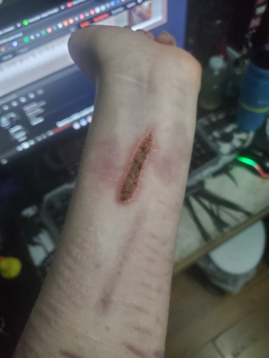 59_SINNER's tweet photo. Some burns I've done #shtwt #selfharm #sh https://t.co/aGkgtwWMTQ