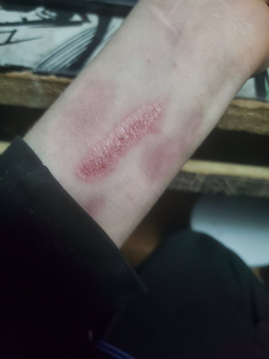 59_SINNER's tweet photo. Some burns I've done #shtwt #selfharm #sh https://t.co/aGkgtwWMTQ