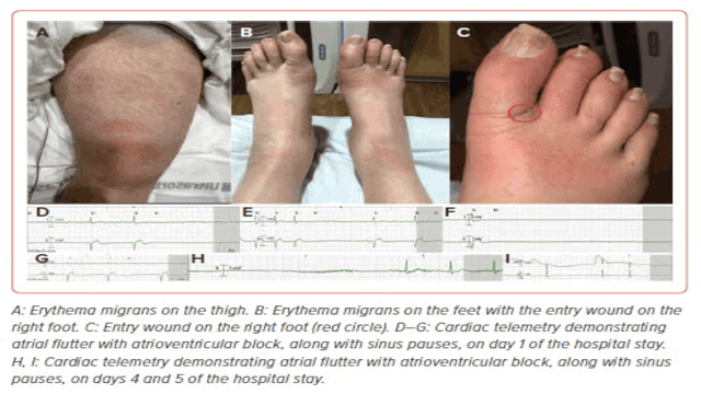 radcliffeCARDIO's tweet image. 📚 New #USCJournal Article: "High-grade AV Block Due to Lyme Disease"

📚 Just Published!

🔓Access it here 👉 ow.ly/ZAt5106vZzv

@AnkurKalraMD @CardioNerds #Electrophysiology #Arrhythmia #MedEd