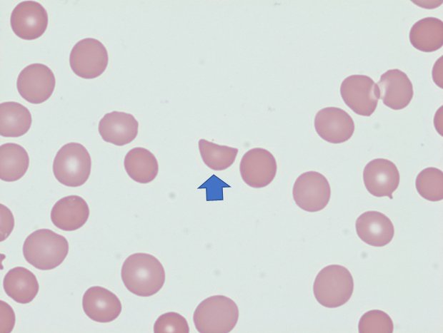 drabdulhameed07's tweet photo. Helmet cells are classically seen in?

A. Hereditary spherocytosis
B. MAHA
C. Iron deficiency anemia
D. Thalassemia trait https://t.co/EvKx97sVcD