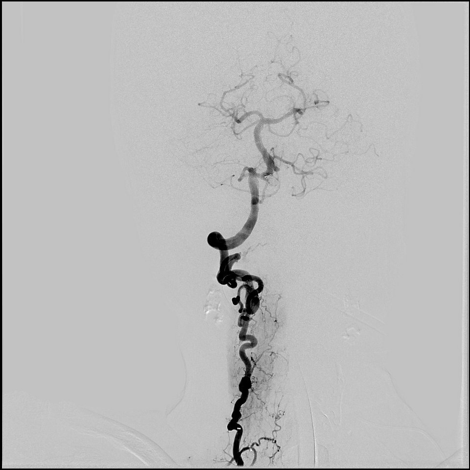 Journal of Neurointerventional Case Reports tweet media