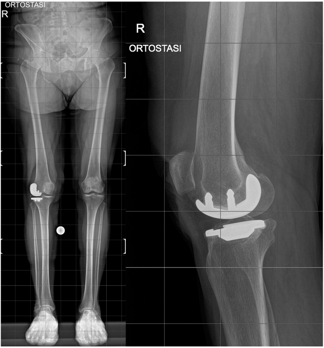 SurgicalTD_MDPI's tweet photo. #mdpiSTD Check out "ROSA™ Imageless Robotic-Assisted Conversion from Unicompartmental to Total Knee Arthroplasty: A Novel Surgical Technique and Case Report" by Elisabetta Giani et al. 
https://t.co/zy7R5dyZHH
@MDPIOpenAccess @Scilit_ @MediPharma_MDPI
#Surgery https://t.co/IqMrF5F0eG