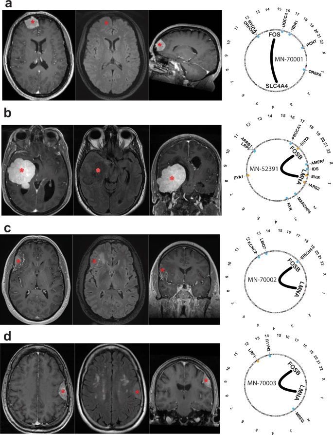 ICOMeningioma's tweet photo. Read the recent study in @NatureComms which analyzes #meningiomas without driver mutations or major chromosomal alterations and identifies a subset with recurrent genomic rearrangements involving the #FOS and #FOSB genes.
https://t.co/56UfoGu2TI https://t.co/BA7i2ZGfIc