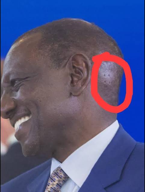 Onorpik's tweet photo. Many have been asking about the four holes once seen on the side of Ruto's head. I believe they are called burr holes, they are made to relieve blood or fluid build up in the head so as to prevent brain damage. https://t.co/rBHYfOkJBK