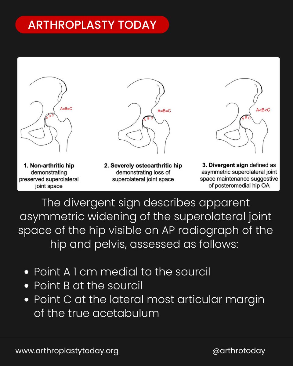 ArthroToday's tweet photo. Can you see it?

The Divergent Sign may reveal posteromedial hip osteoarthritis that hides on standard radiographs.

https://t.co/05LPEHYYsO

#arthroplasty #hipOA https://t.co/HsRmS6SqT2
