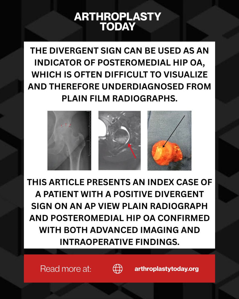 ArthroToday's tweet photo. Can you see it?

The Divergent Sign may reveal posteromedial hip osteoarthritis that hides on standard radiographs.

https://t.co/05LPEHYYsO

#arthroplasty #hipOA https://t.co/HsRmS6SqT2