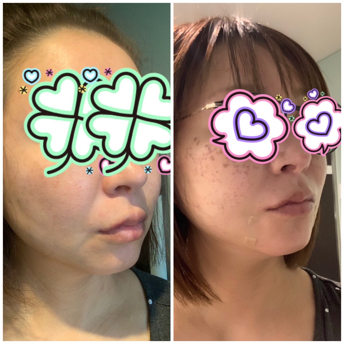 superkokojiji's tweet photo. 何度か糸リフトやったけど、ラポエルクリニックが1番良い！！
ずっと気になってた口の横のポニョが無くなった！
切開リフトするまではリピ確定！
先生もフレンドリーで面白い🤣
#rappoelclinic #ラポエルクリニック
#韓国 https://t.co/ev78jjrxT0