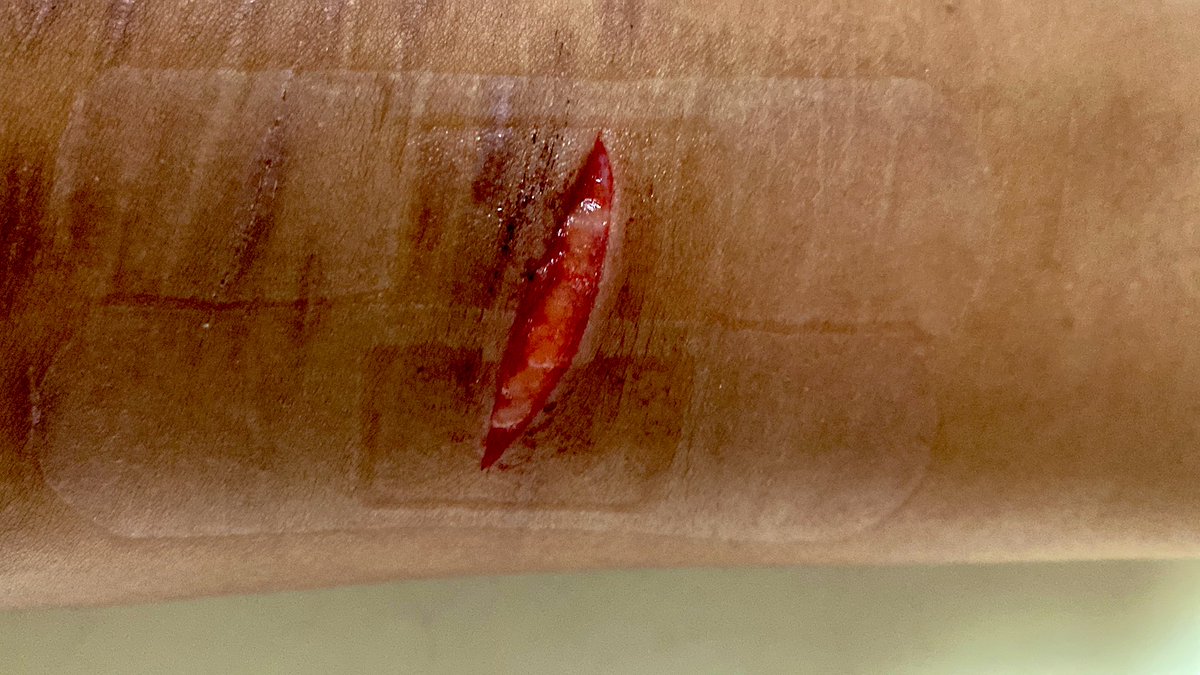 the scar shrinkage gonna be so bad 🫩