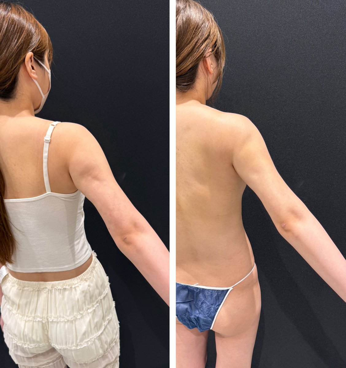 脂肪吸引/豊胸 最上由基 tweet media