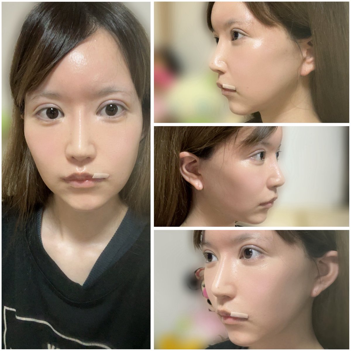 うる@切開リフトDT tweet media