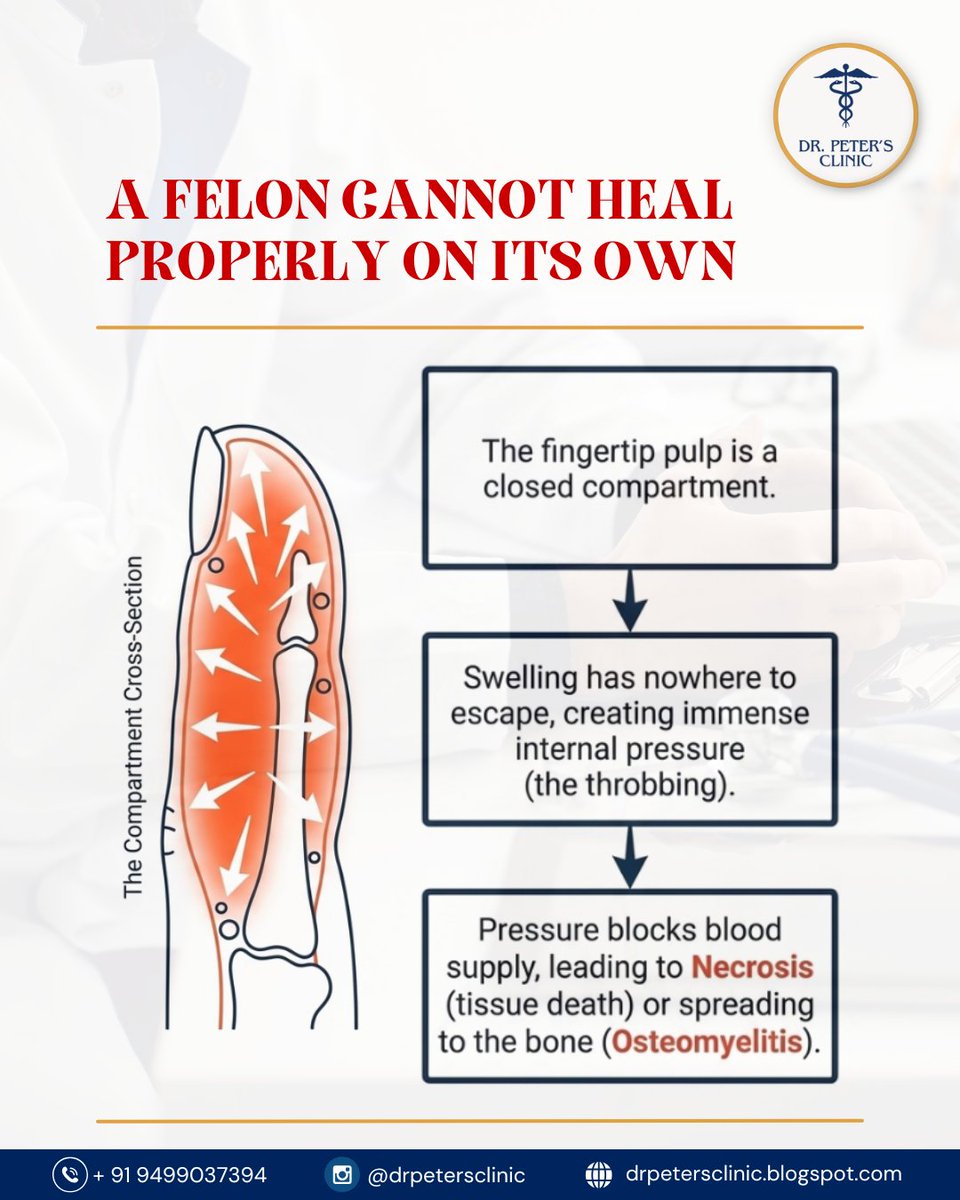drjohnpeter27's tweet photo. A splinter. A nail bite. A tiny cut.
That's all it takes for a Felon Finger — a closed-compartment infection that builds pressure until it destroys tissue and hits bone.
Catch it early. Miss it → surgical drainage, osteomyelitis, permanent damage

#FelonFinger #MedicalAwareness https://t.co/0LjwlZq5tt