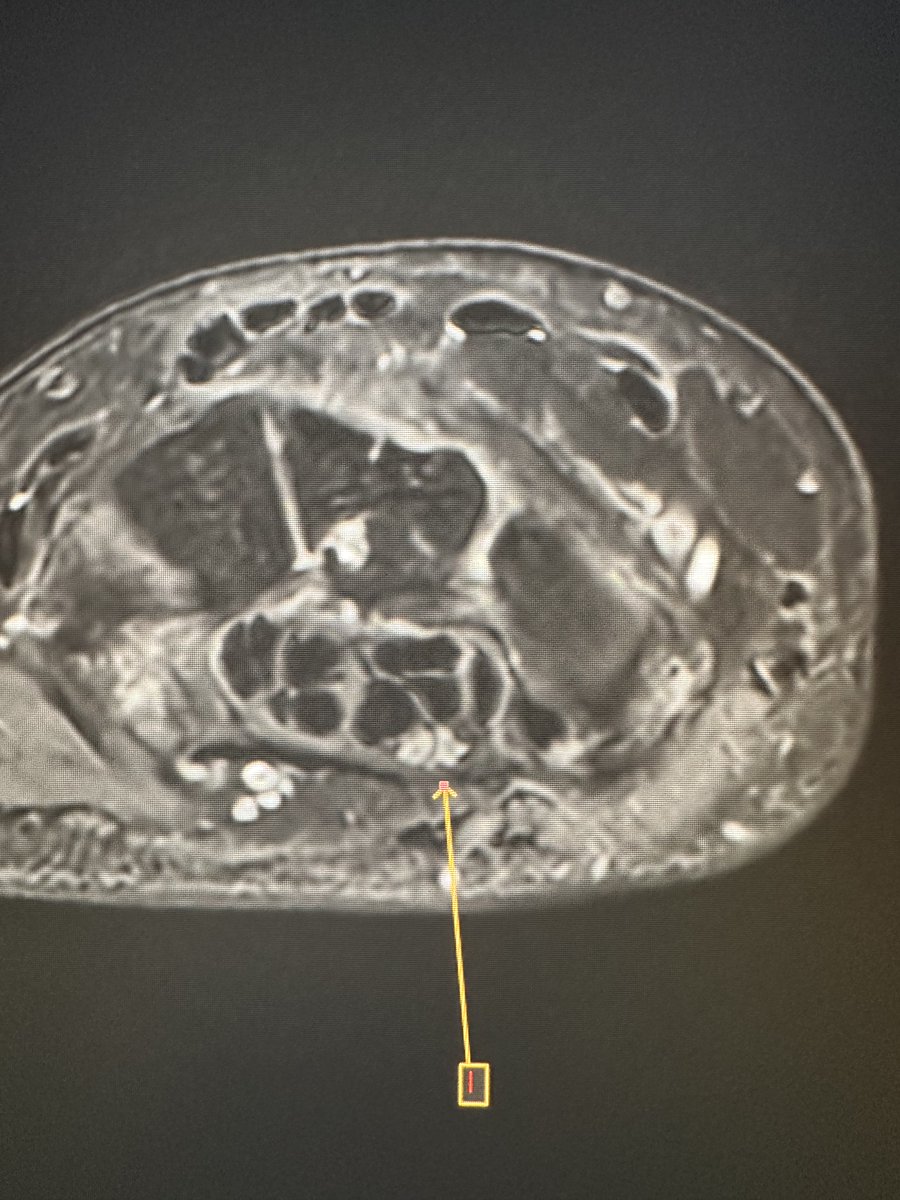 northwoods1980's tweet photo. Nice example of a normal anatomic variant, bifid median nerve wo the persistent median artery. Somewhere around 10% of humans. https://t.co/xT8MMyQ7Jx