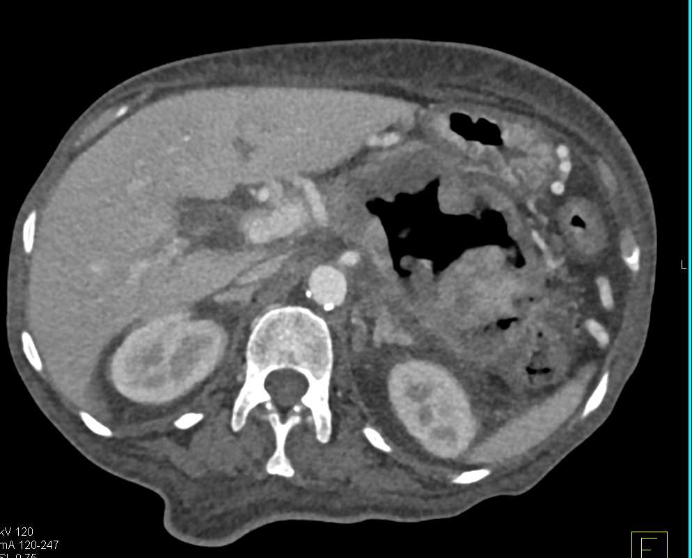 Elliot K Fishman / CTisus.com tweet media