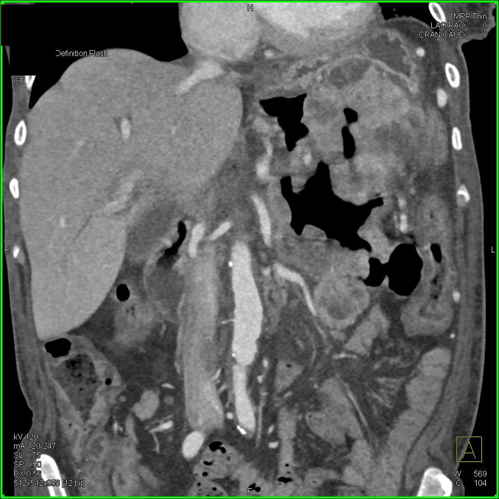 Elliot K Fishman / CTisus.com tweet media