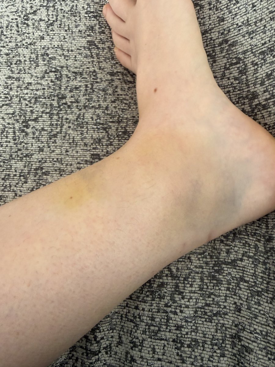 Wear shin guards kids 🤣🤣🤣😮‍💨😮‍💨😮‍💨