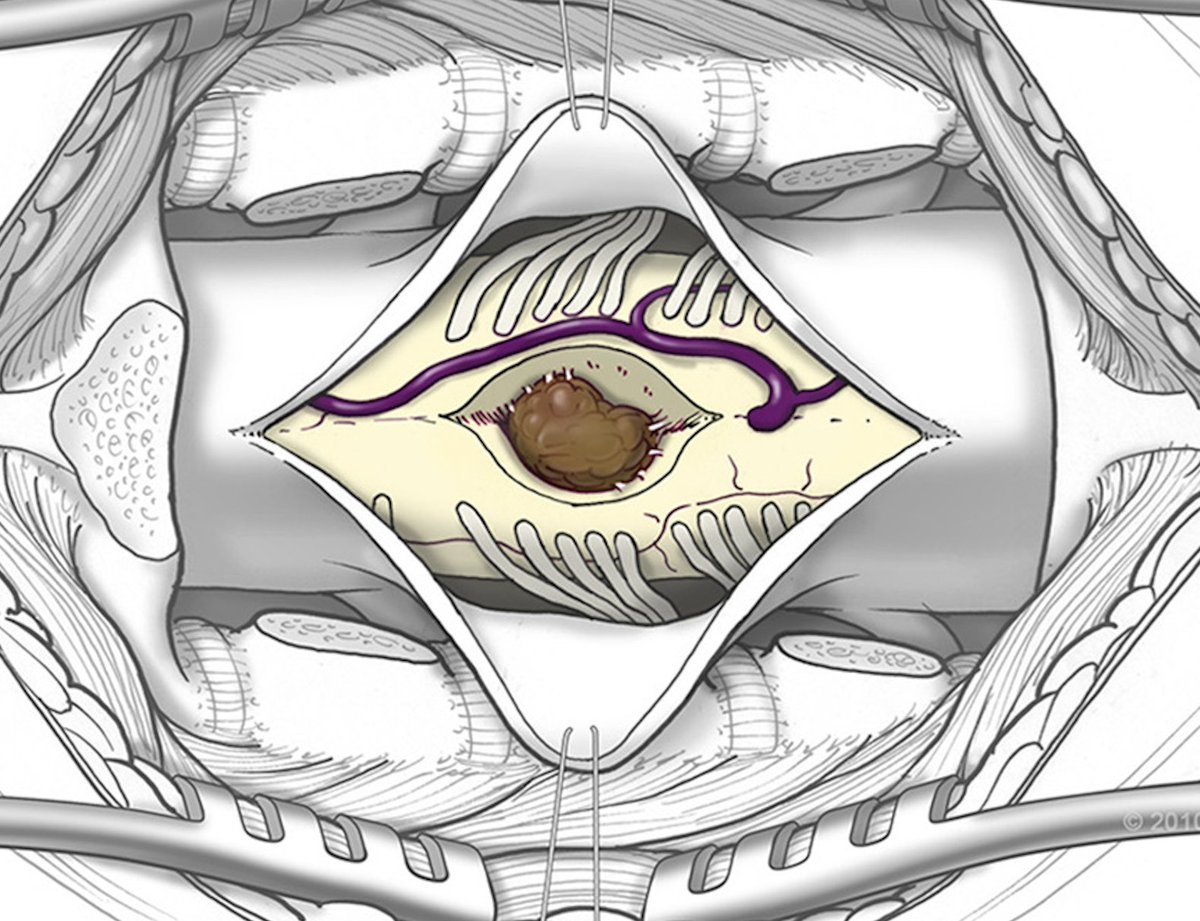 Michael T. Lawton, MD tweet media