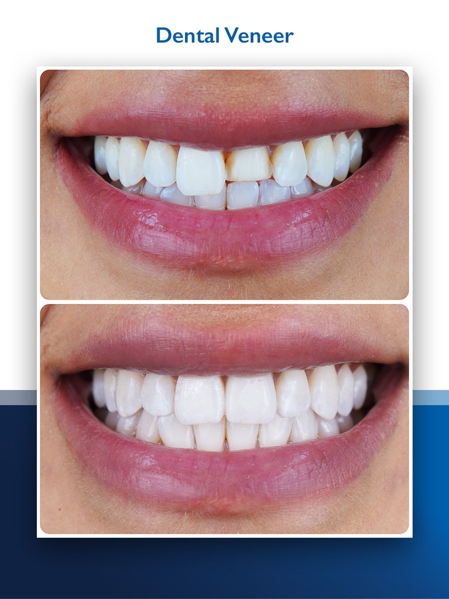 Sometimes, all it takes is a single veneer to transform a smile. ✨

Case in point, this patient enhanced her smile with just one veneer under the expert care of our general and cosmetic dental specialist, Dr. Claude Haddad.

Ready for your own subtle smile upgrade? DM us today
