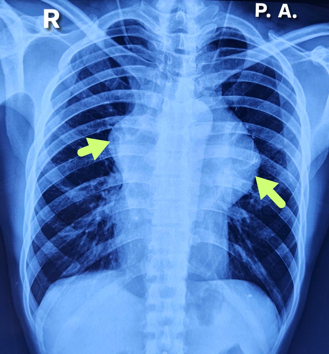 albertoortegana's tweet image. Radiology case-543 
H/0-37 year old patient presented chronic chest pain, fever and weakness..CXR-PA done and showing abnormalities..
What is your diagnosis?

#radiology #radiologia #mbbs #lung #Heart #fbpost #viral 
@dr_manish_ydv @Dr_Shiv_kumar_ @DrMedica_13 @drobiy12 @hemo_shk
