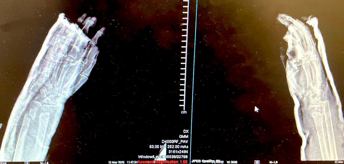 Dr_Dive's tweet image. Una fractura 🦴 duele; pero el dolor no debe ser parte del tratamiento. 
En #Eco #HGT los rotantes no solo aprenden a valorar neuro, cardio, etc; aprenden a intervenir con precisión. 
✅ Analgesia regional ecoguiada
✅ Menos dolor ➡️ menos opioides o sedación innecesaria 
✅