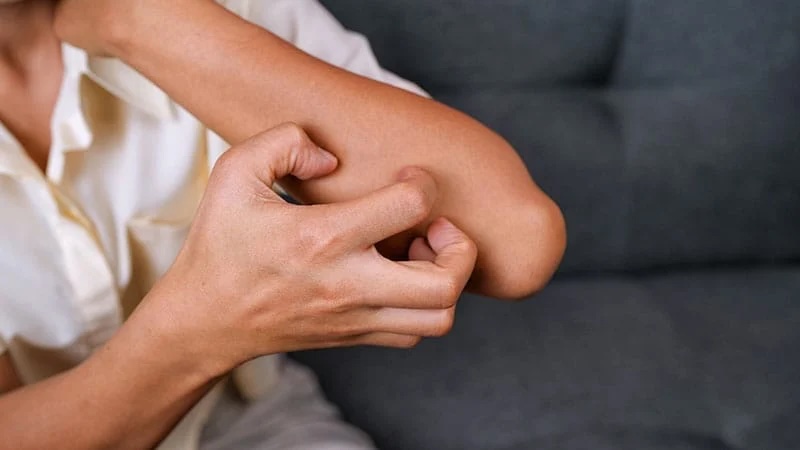 Aller_MD's tweet photo. #Barzolvolimab shows promise for #chronic #spontaneous #urticaria, with half of patients maintaining complete response seven months post-treatment. The drug's unique mechanism may offer new options for #antihistamine-#refractory cases. https://t.co/tBrXsQh9ru https://t.co/un9XAftDfa