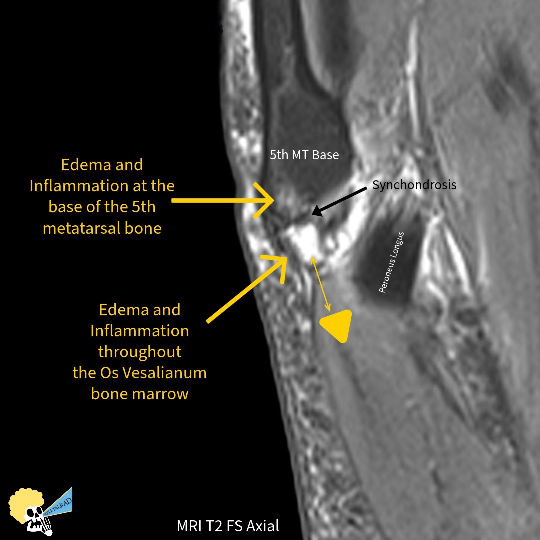 skeletalrad's tweet photo. Uncommon Painful Os Vesalianum. 

#mskrad https://t.co/mCd16k6cLd