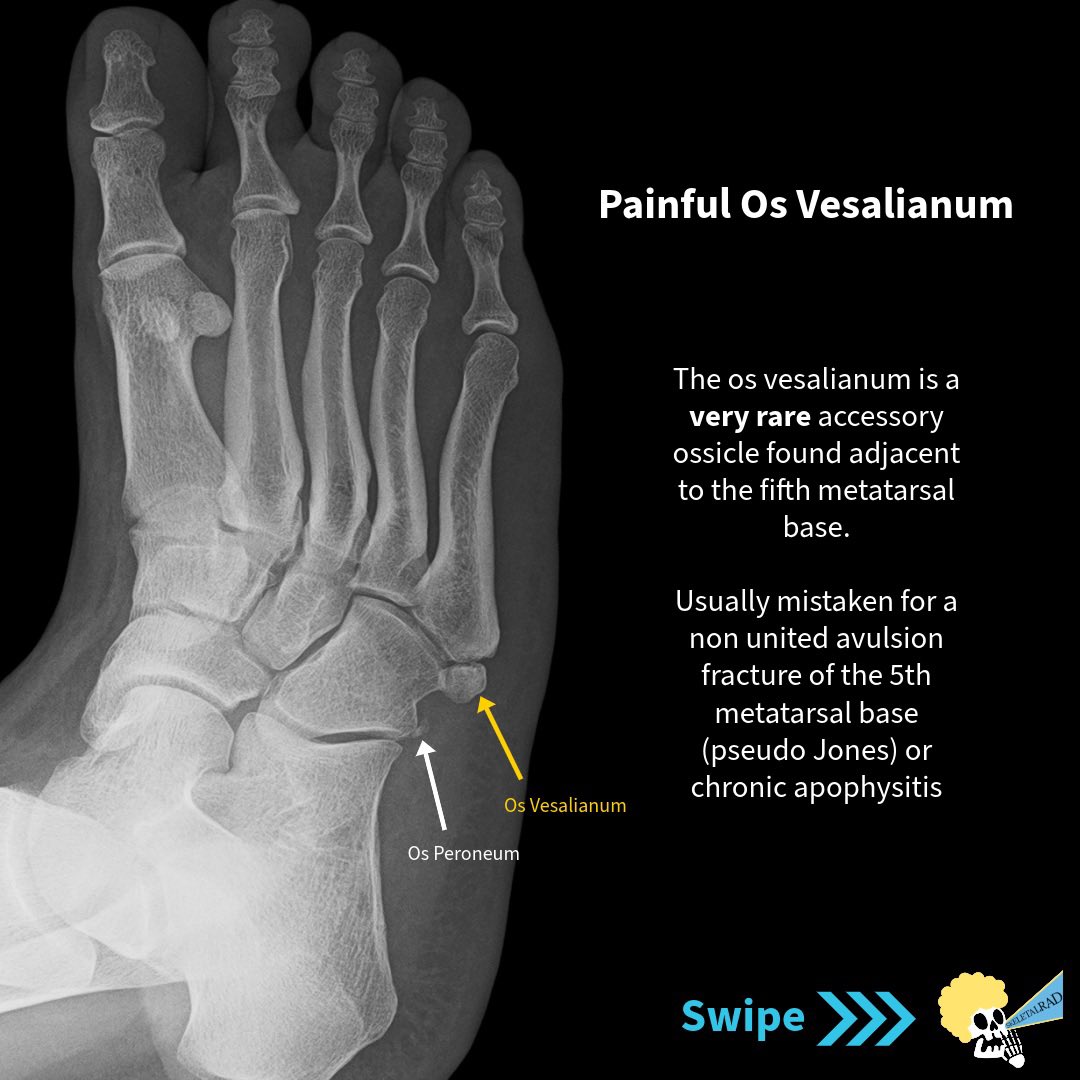 skeletalrad's tweet photo. Uncommon Painful Os Vesalianum. 

#mskrad https://t.co/mCd16k6cLd