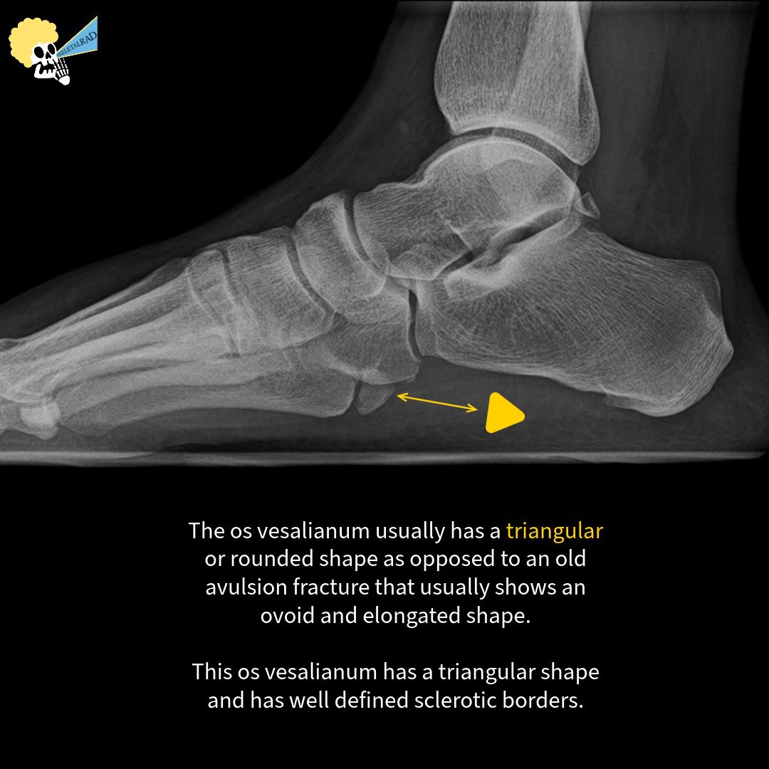skeletalrad's tweet photo. Uncommon Painful Os Vesalianum. 

#mskrad https://t.co/mCd16k6cLd