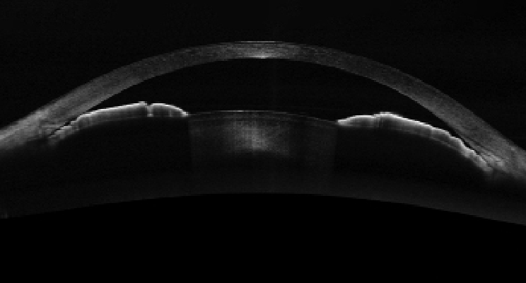 revoptom's tweet photo. Anterior Chamber Depth Narrows Faster at Younger Ages, Then Stabilizes
A Japanese cohort showed structural predisposition to angle-closure appears to be largely established by early middle age.
https://t.co/A1yJ8Ra9jd
#angleclosure #optometry #eyecare https://t.co/GEOQPUq231