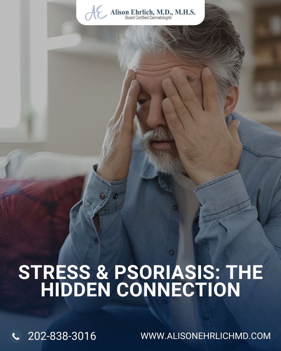 alisonehrlichmd's tweet image. Major life stressors like illness, work pressure, or emotional trauma may trigger psoriasis. Studies report up to 50% of patients notice flares after stress. A personalized treatment plan can help.

#PsoriasisRelief #Inflammation #SkinCondition #DermCare