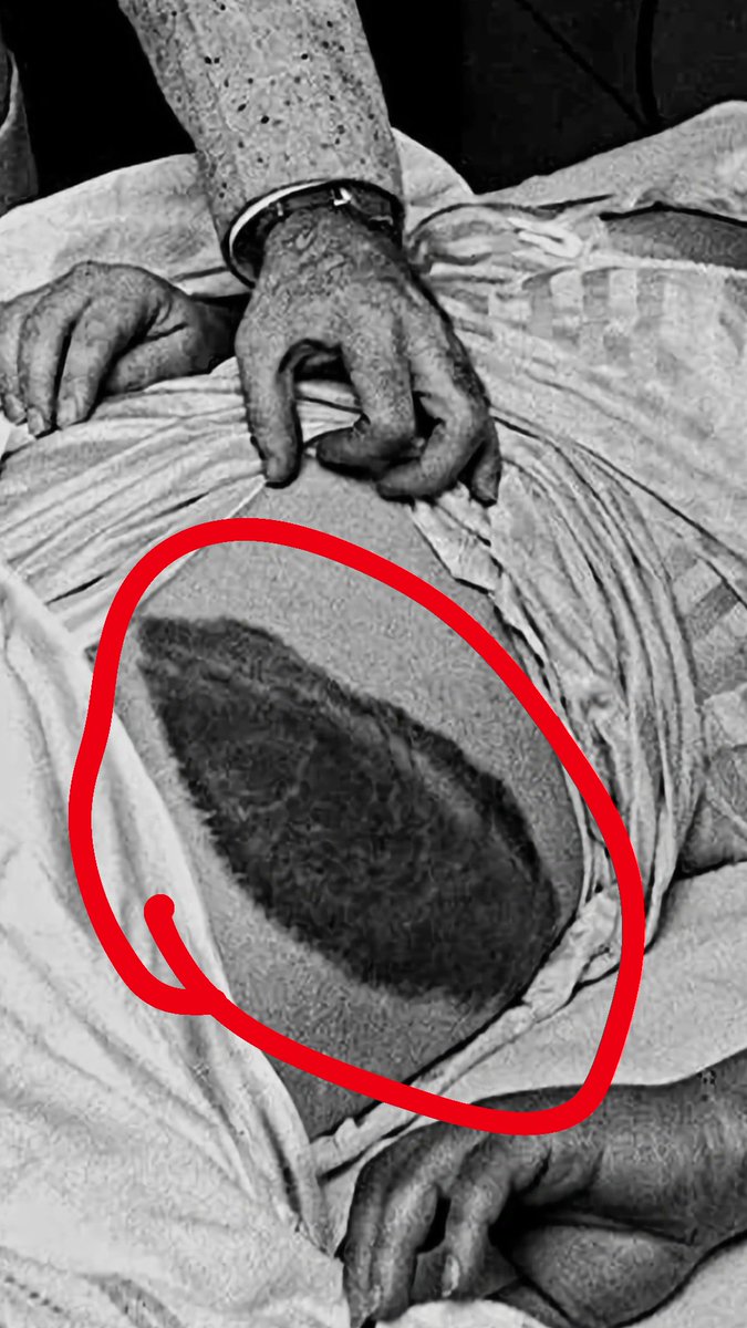 UnrealPOV's tweet image. A TRACE OF A COSMIC CURSE ☄️

In 1954, Ann Hodges was struck by a 4-billion-year-old meteorite while napping. ☄️ ​🪐 

She remains the ONLY person in history hit by a space rock. 🚫

​#Paranormal #Cosmic #UnrealPOV