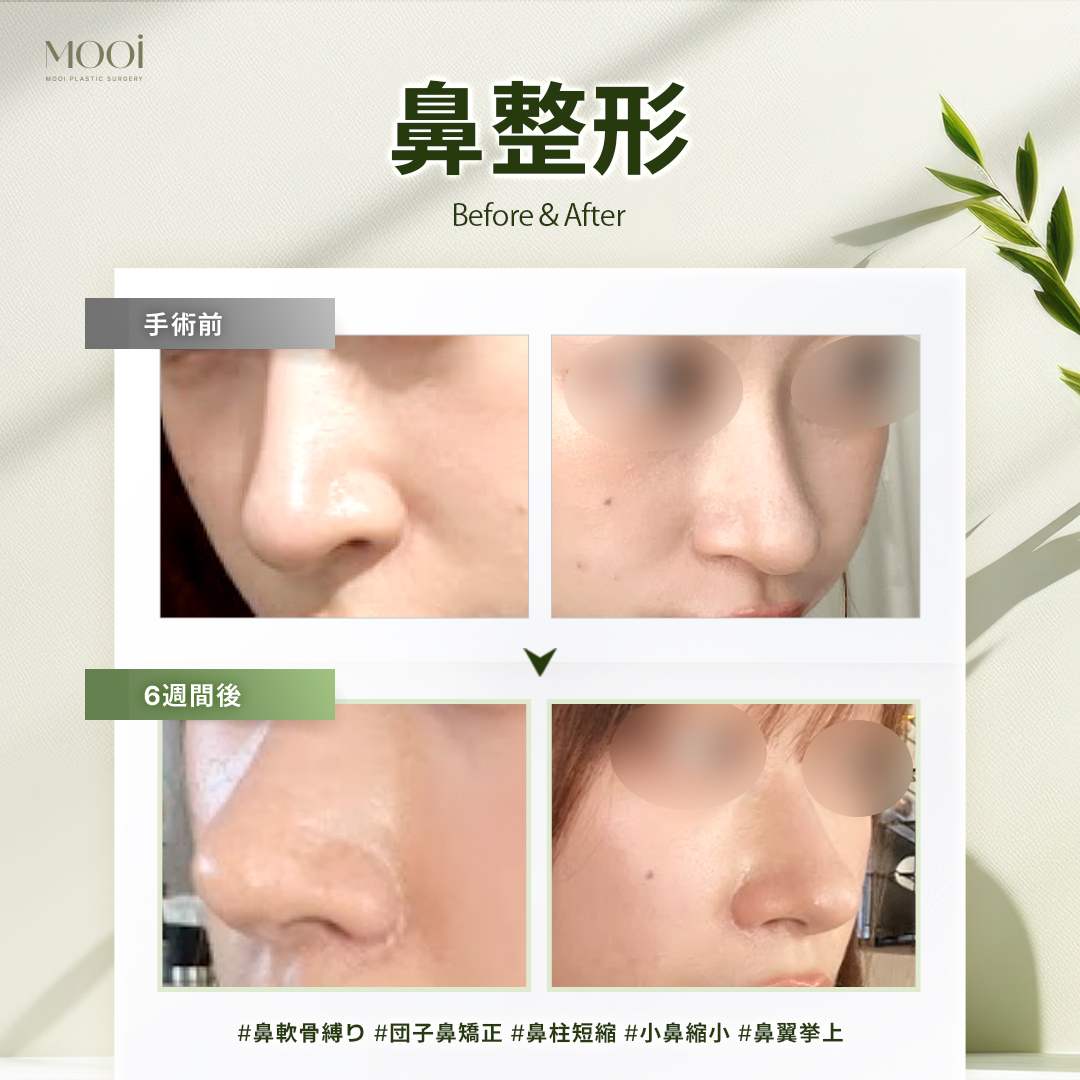 MOOi (ムイ) 整形外科 tweet media