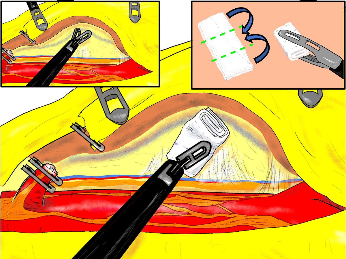 Japan Society for Endoscopic Surgery (JSES) tweet media