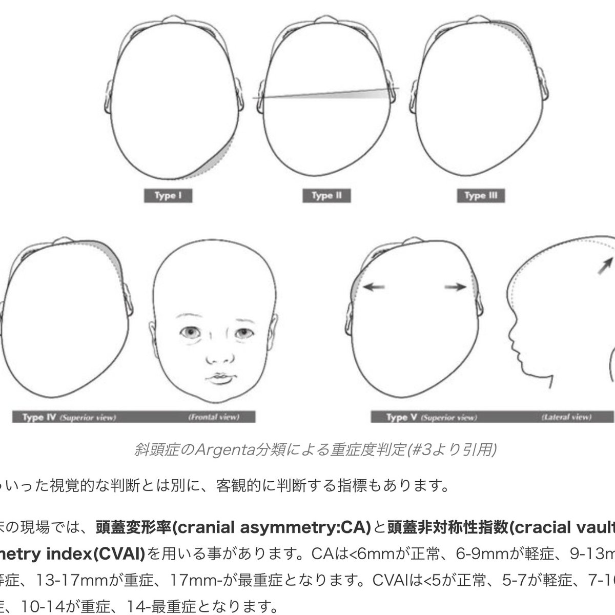 doctor_nw's tweet photo. 【無料】赤ちゃんの頭の形の歪みは予防できる？また治療にはどのような方法がある？外来でも多い質問ですが、具体的な方法を解説しました。無料で読めます
